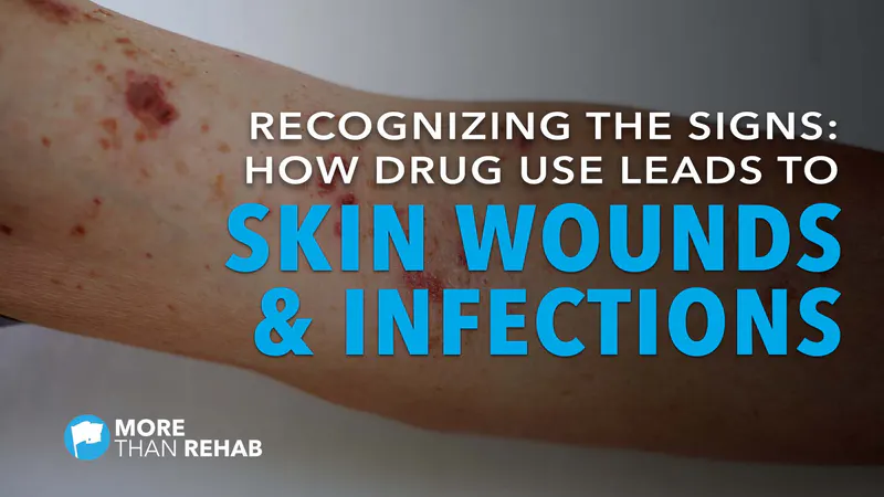 skin-wounds-necrotizing-fasciitis-staphylococcus-aureus-infectious-diseases-methamphetamine-abuse